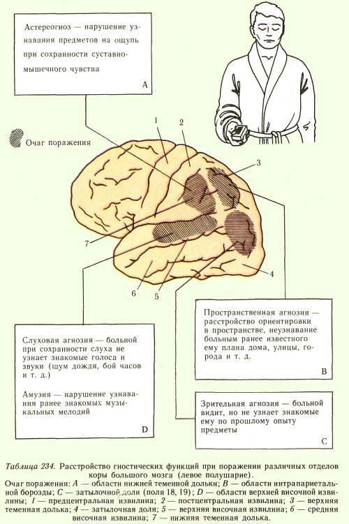 Нарушение гнозиса