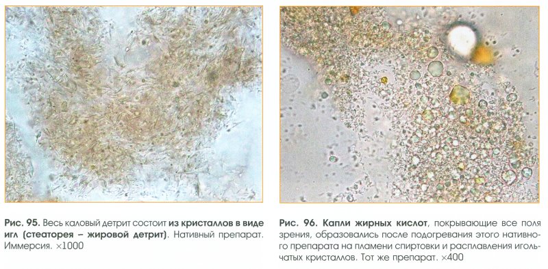 Стеаторея фото